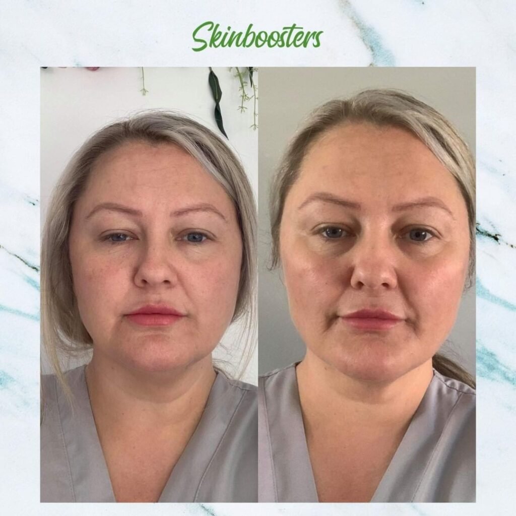 Snapinsta.app 327586487 3330308747230668 5709694440334774706 n 1080 Skin Booster Gone Wrong: These Before and After Photos Are Jaw-Dropping!